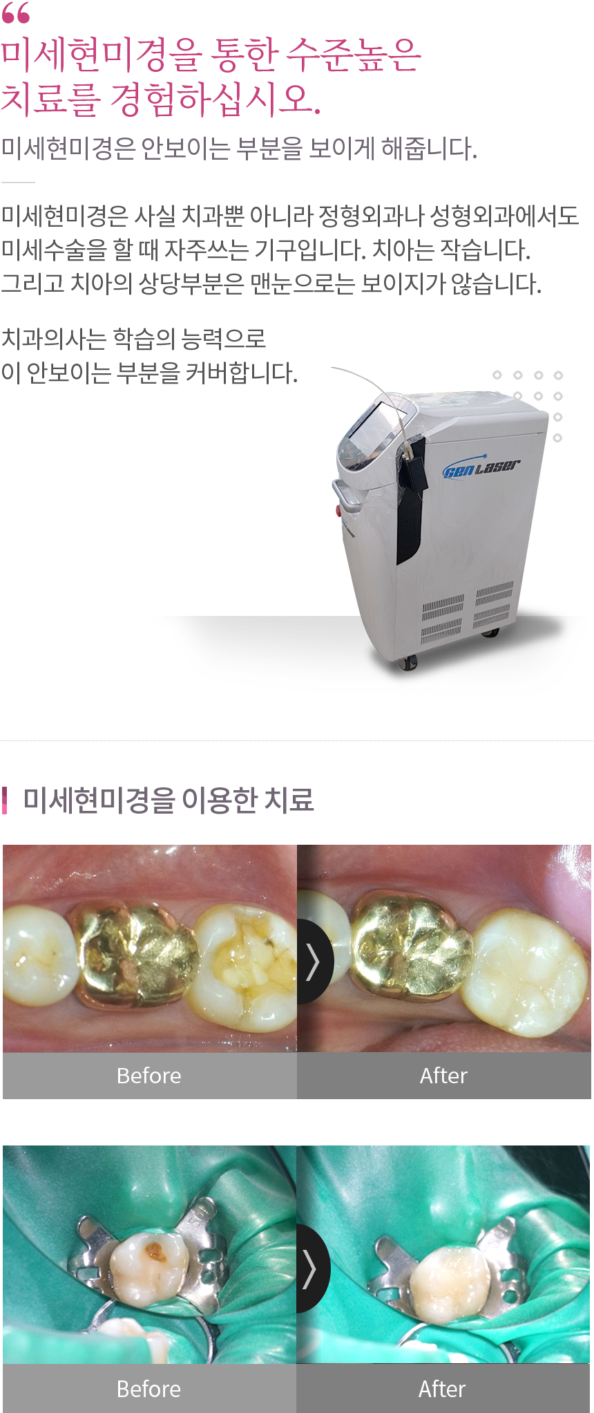 미세현미경 및 레이저 내용