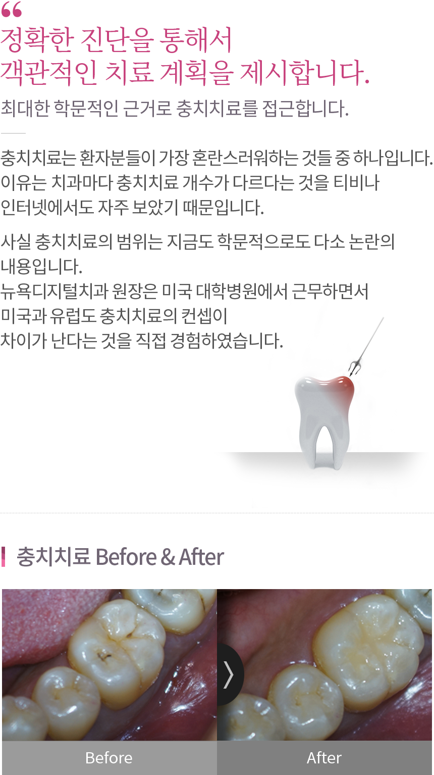 충치치료 내용