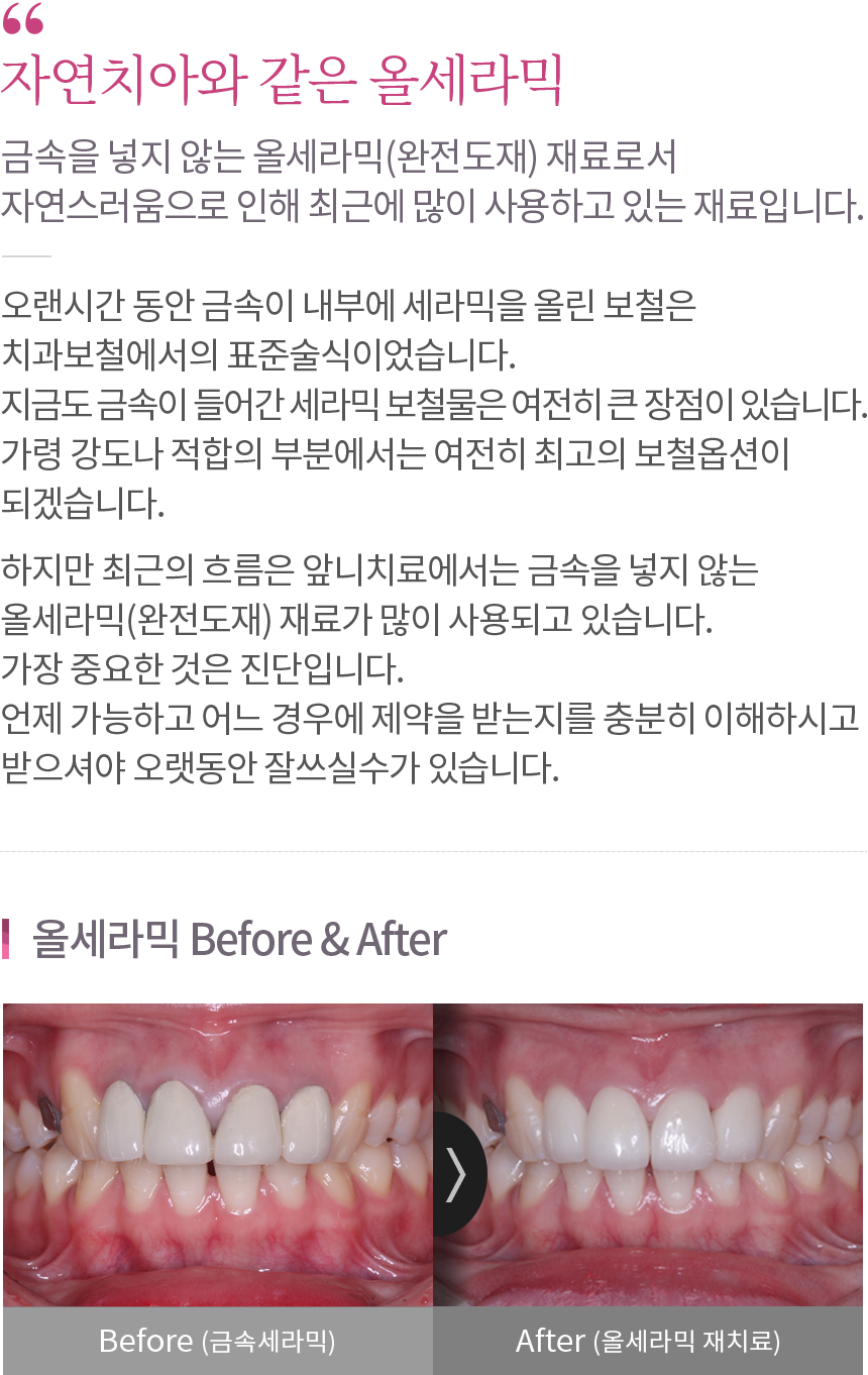 올세라믹 내용