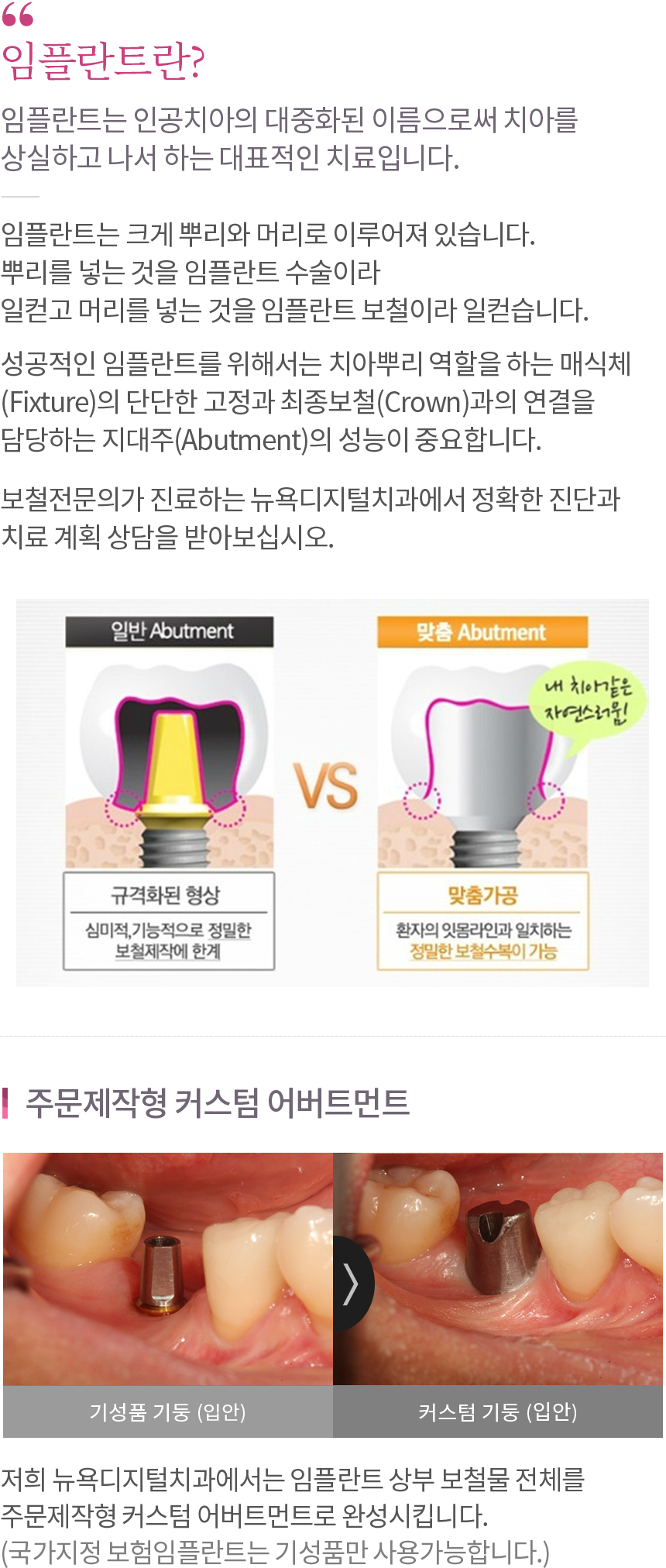 임플란트 내용